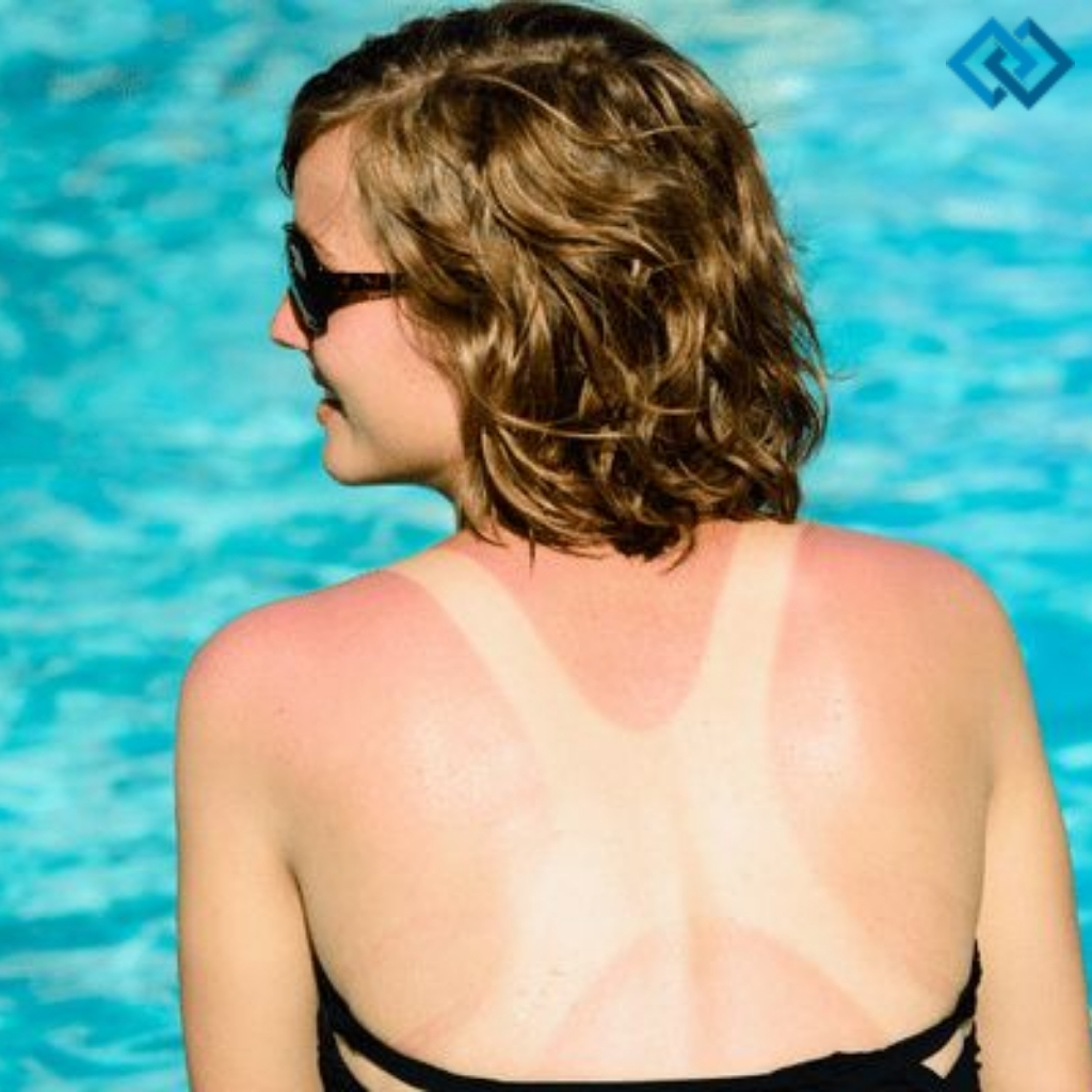 Sunburn Instagram Captions